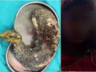 15കാരിക്ക് ട്രിക്കോബെസോര്‍! അകത്താക്കിയത് രണ്ടു കിലോ തലമുടി! സംഭവം തിരുവനന്തപുരത്ത്...