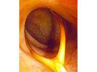 ഭക്ഷണം കഴിക്കുന്നതിനിടെ  72വയസ്സുകാരന്റെ  വന്‍കുടലില്‍ കുടുങ്ങിയ കോഴിയെല്ല്: പിന്നീട് പുറത്തെടുത്തു