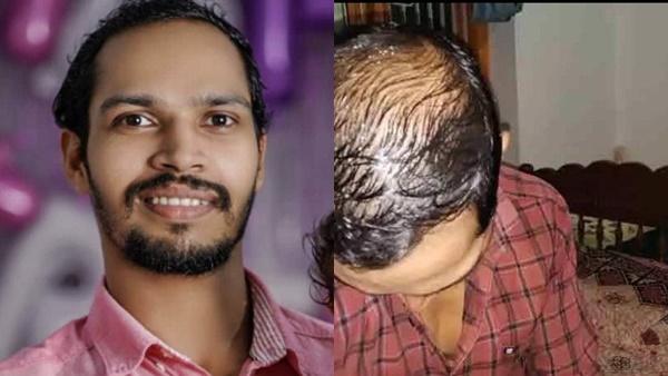 മുടികൊഴിച്ചിലിന് പരിഹാരം തേടിയായിരുന്നു