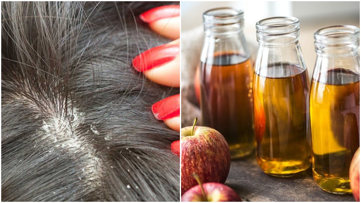 apple cider vinegar for dandruff Here are 5 ways to remove dandruff