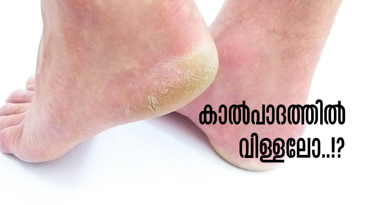 Skin Care Tips Here Is How To Heal Cracked Heels With Home Remedies