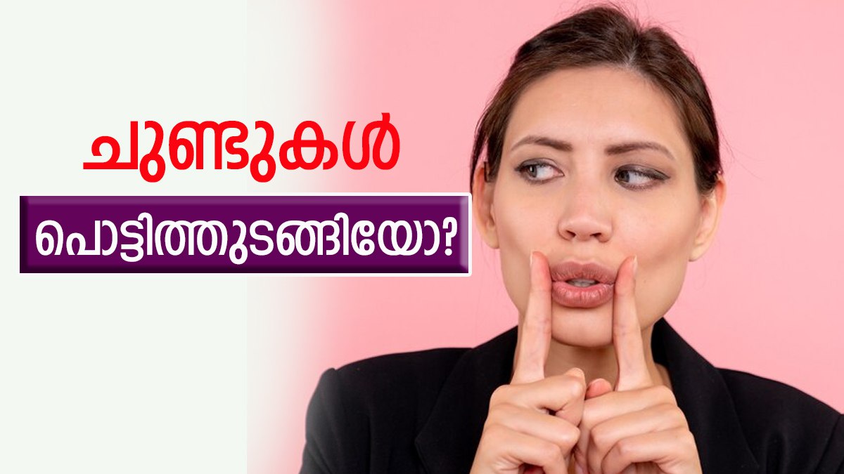 ചുണ്ടുകൾ വരണ്ടുപൊട്ടിത്തുടങ്ങിയോ? ഇക്കാര്യങ്ങൾ ചെയ്യാനേ പാടില്ല
