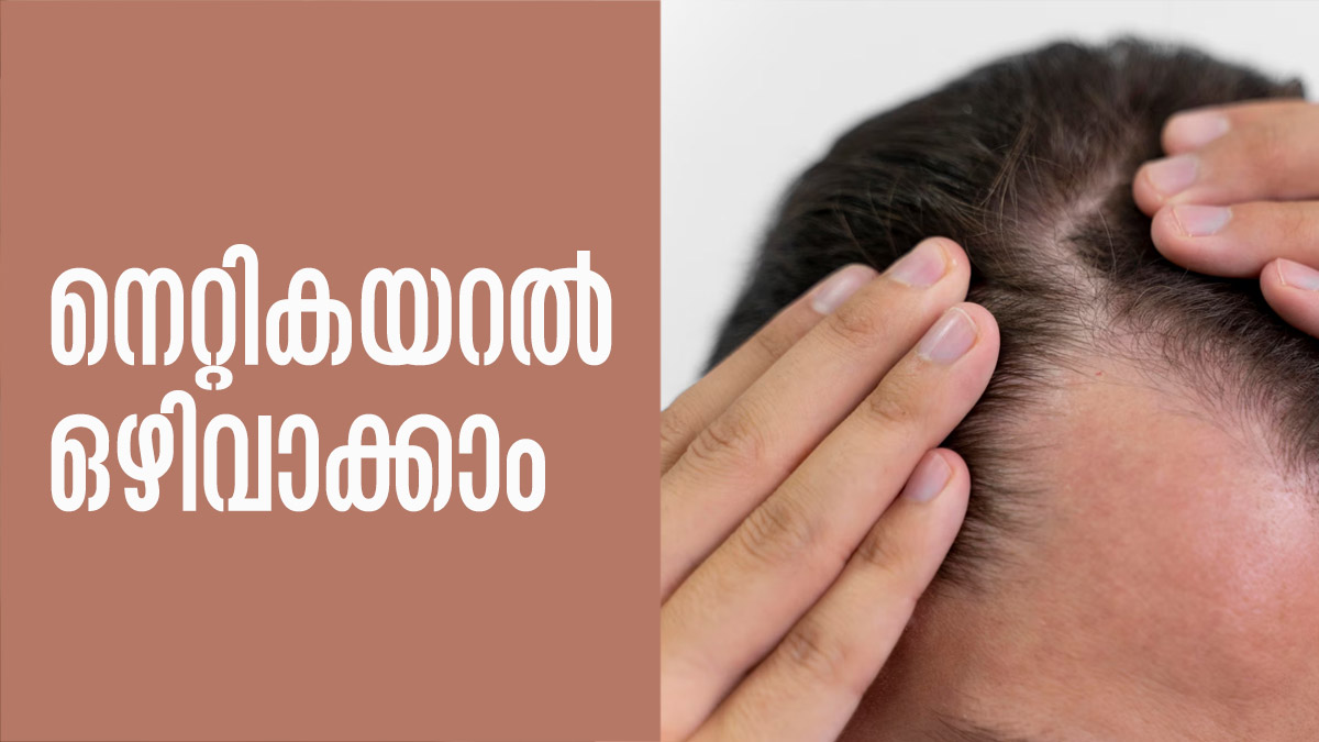 നെറ്റികയറുന്നോ..? കഷണ്ടിയാകുമോ? പേടിക്കേണ്ട വീട്ടില്‍ തന്നെയുണ്ട്